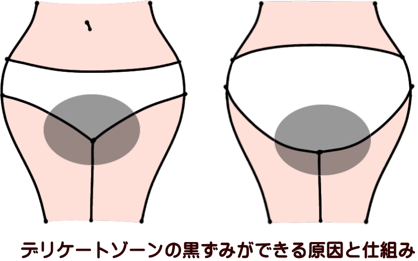 デリケートゾーンの黒ずみができる原因と仕組み